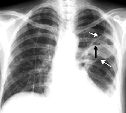 Cách ngừa viêm phổi do tụ cầu